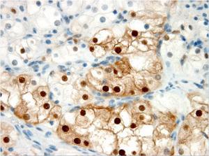 clear cell renal carcinoma 